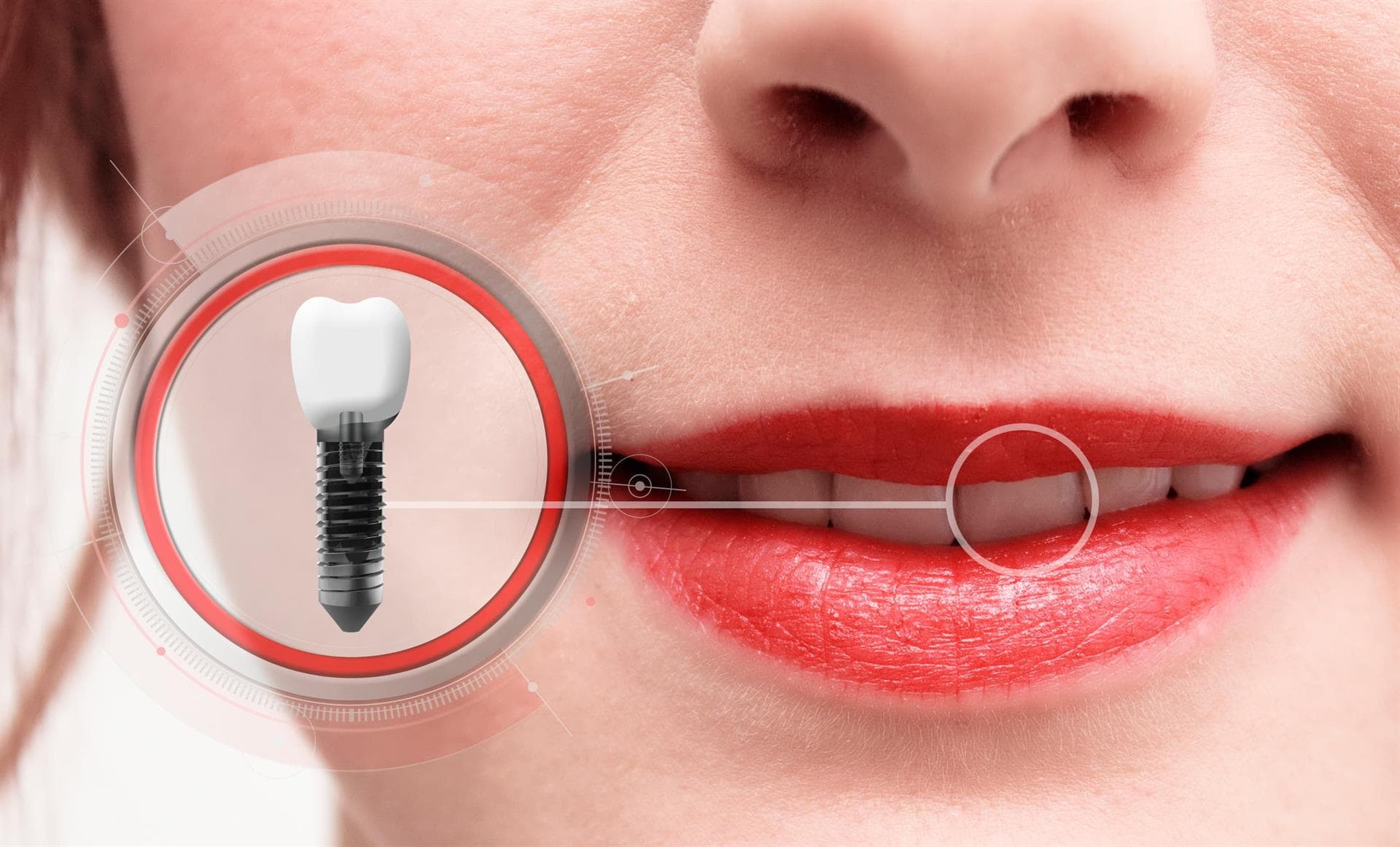Centro Odontológico Dentine - Implantología